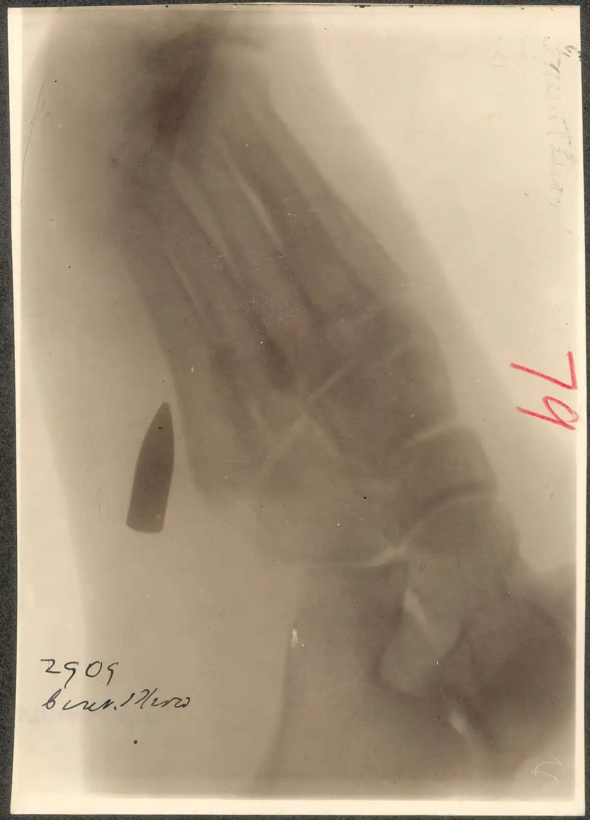 Fratura de Falange (Dedo)